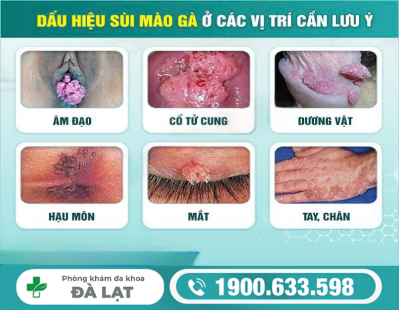 BỆNH SÙI MÀO GÀ Ở ĐẦU KHẤC NAM GIỚI
